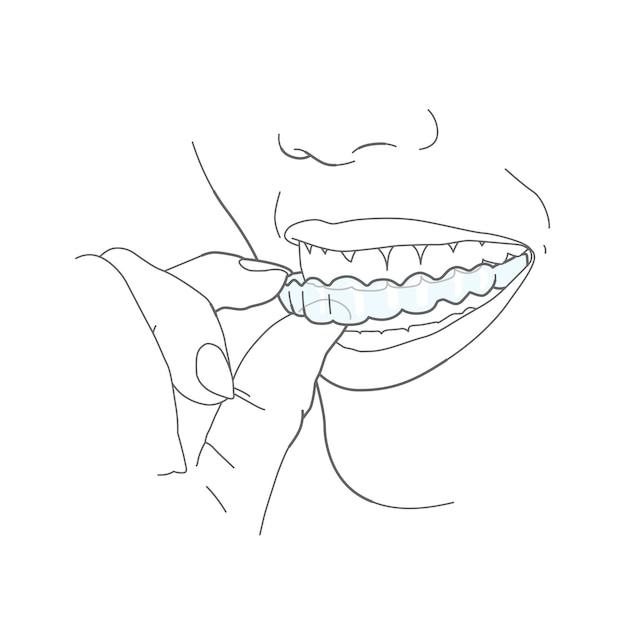 invisalign moving teeth