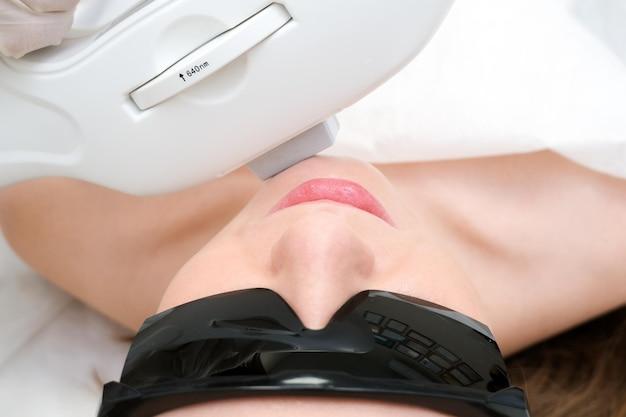 laser hair removal chin women