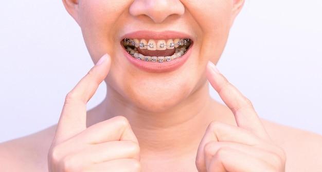 reasons for braces in adults