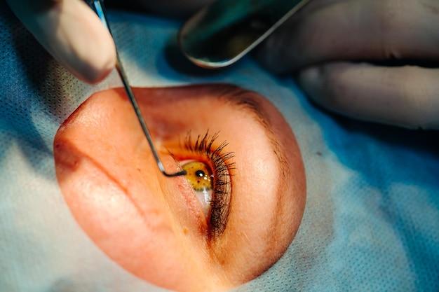 clr eye surgery