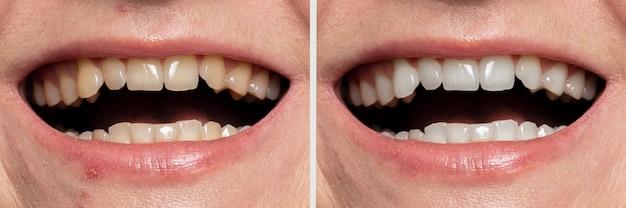 can orthodontist fix chipped tooth