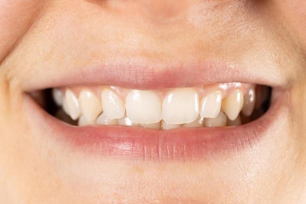 can orthodontist fix chipped tooth