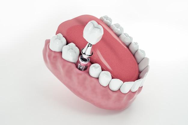 can 1 implant replace 2 teeth
