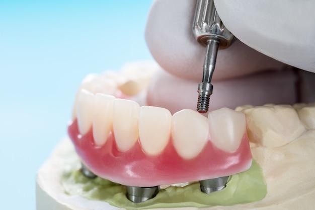 all on 4 dental implants cost california