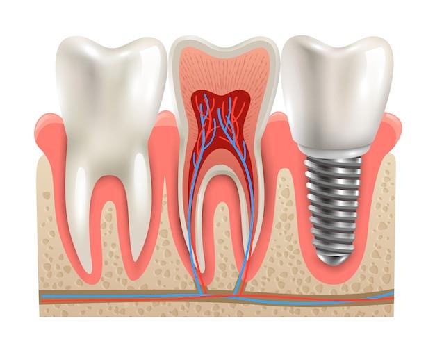 dental implant cost indiana