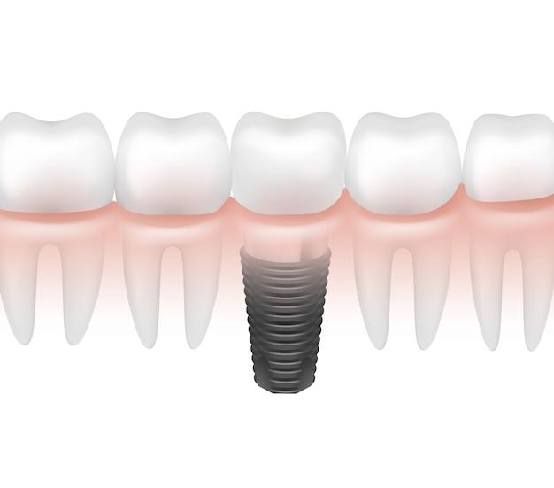 dental implant without crown