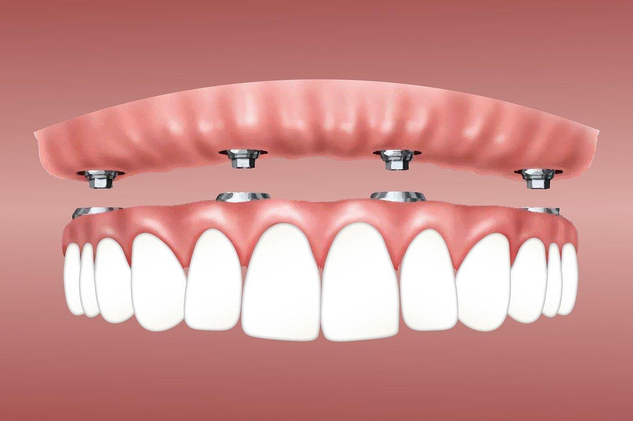 dental implants mn cost