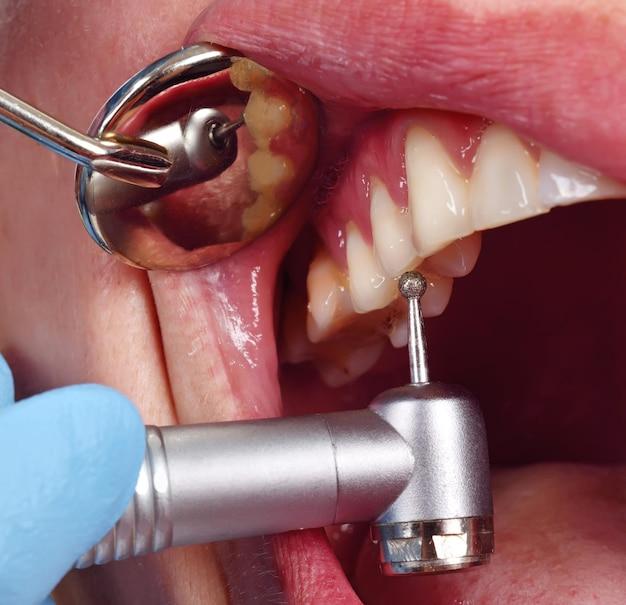 drill free dentist