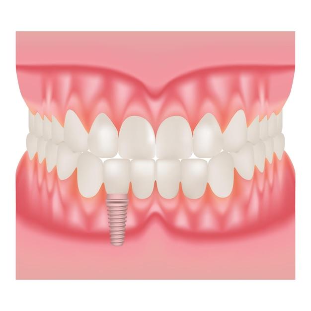 full on 5 dental implants
