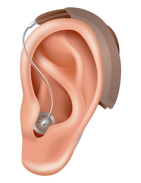 hearing aids for perforated eardrum
