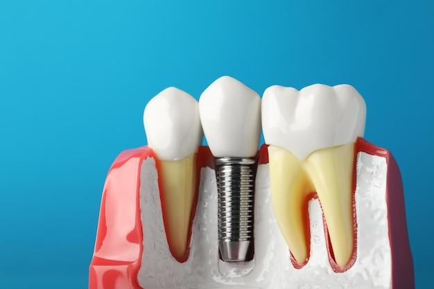 how much are dental implants in ky