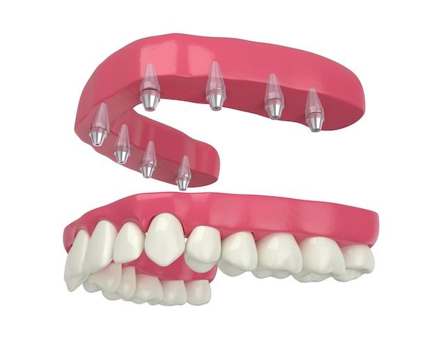 how much does invisalign cost for upper teeth only
