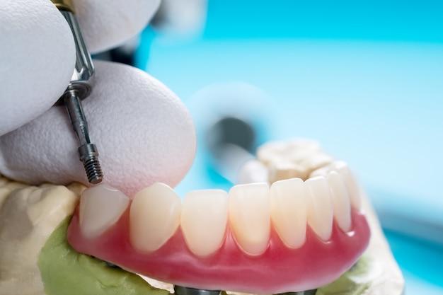 laser dental implants cost