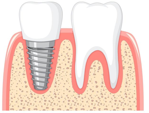 laser dental implants cost