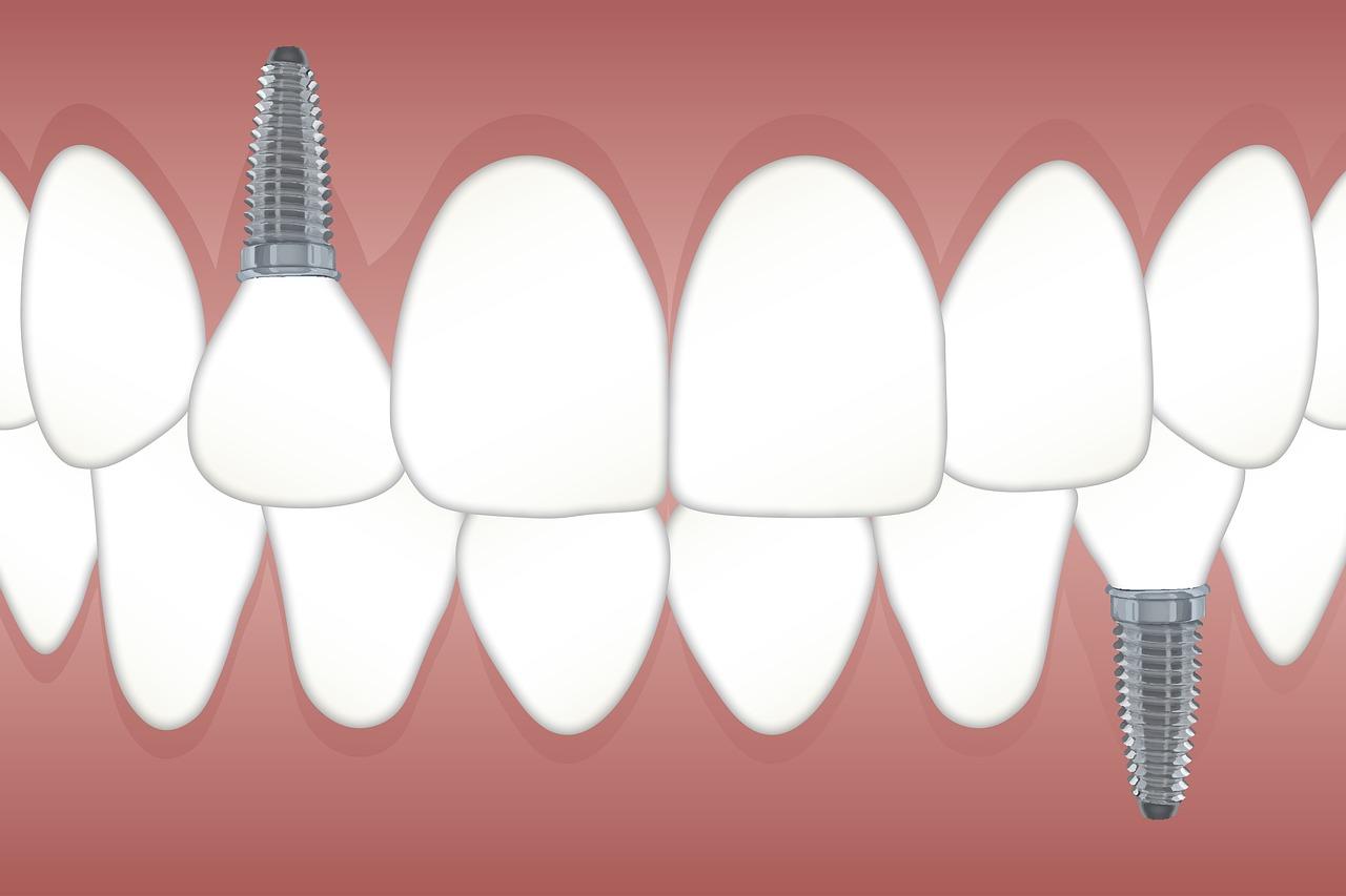 lupus dental implants