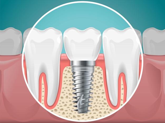 no bone solution dental implants cost