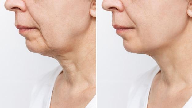 non invasive face lift before and after