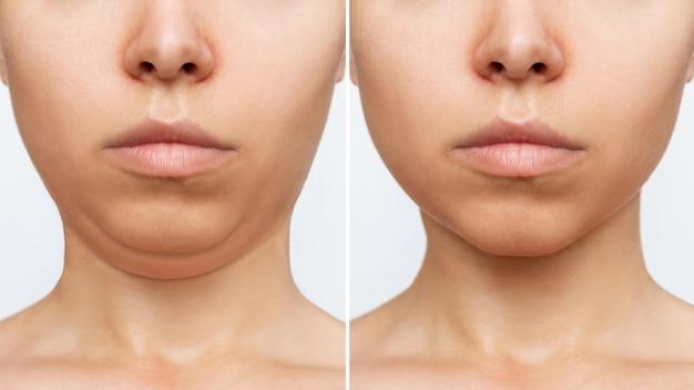 non invasive face lift before and after