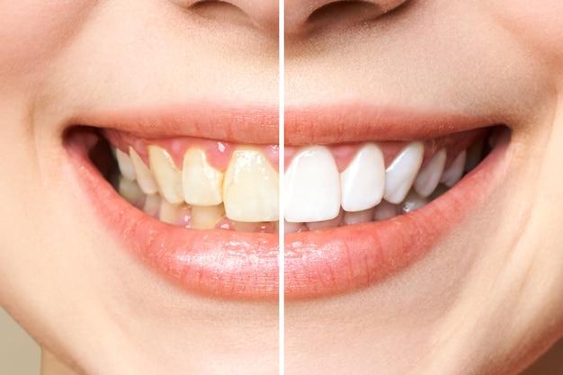 does teeth cleaning make your teeth whiter