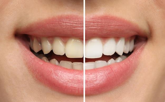 teeth whitening one session
