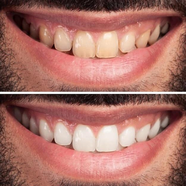 teeth whitening one session