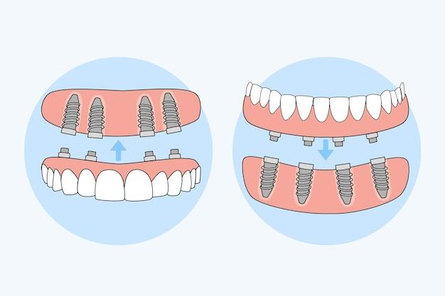 omeprazole and dental implants