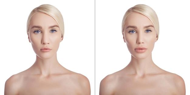 vbeam rosacea before and after
