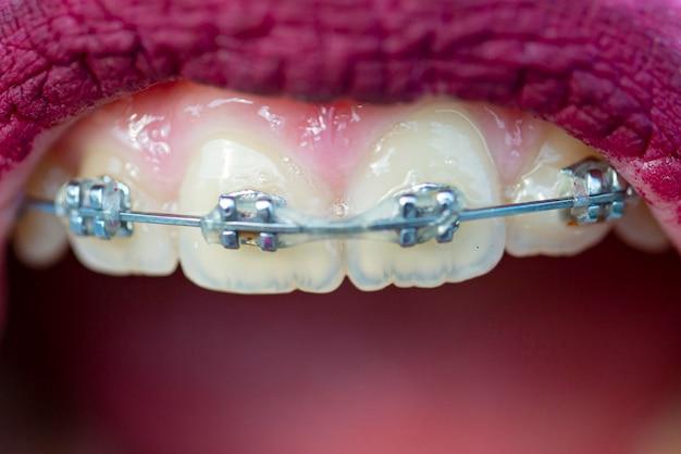 thick wire braces