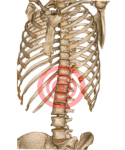 thoracic spine injury settlement