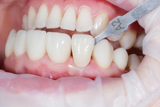 two front teeth on one implant