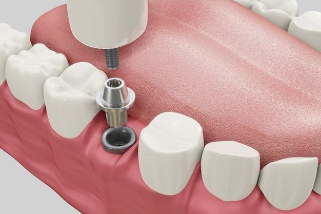 why are dental implants so expensive