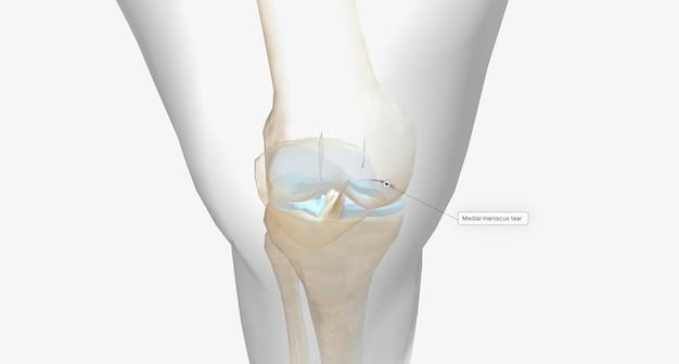 radial meniscus tear