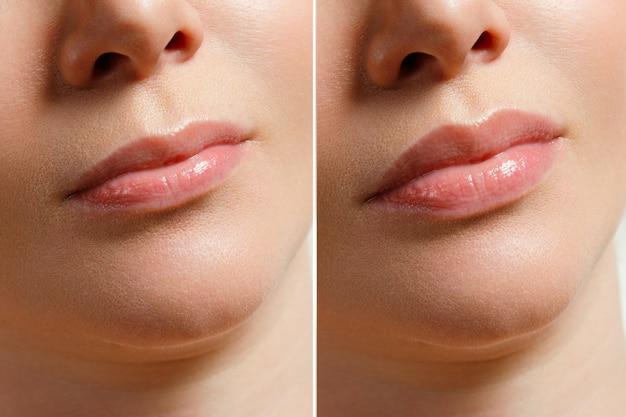 lip filler for aging lips