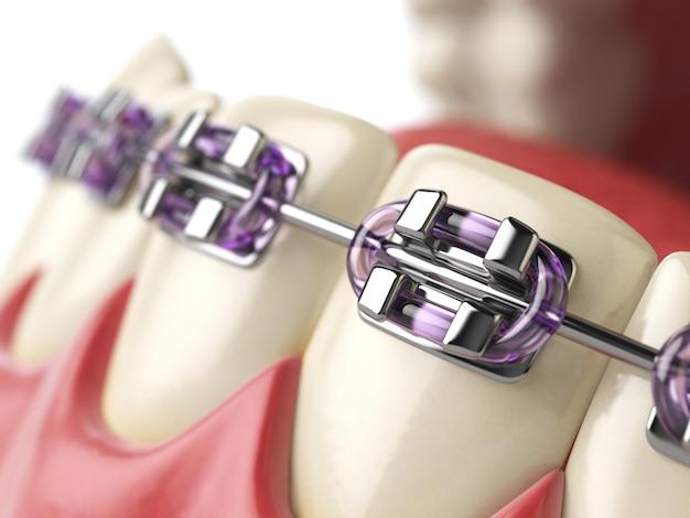 purple braces