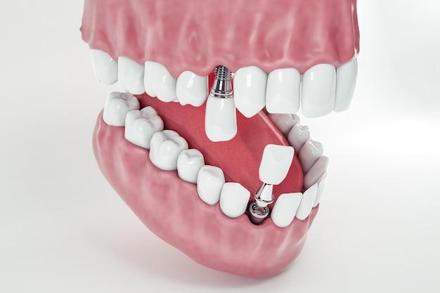 retainer with fake tooth