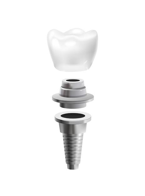 straumann dental implants price