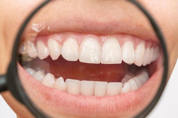  Can Teeth Be Whitened If Enamel Is Gone 