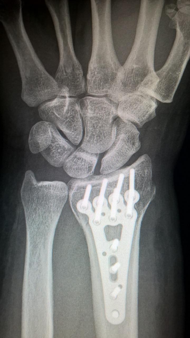  Can Xray Be Done With Plaster 