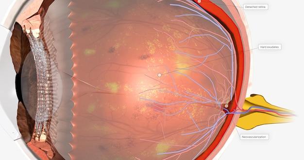 Can you have glaucoma without being a diabetic? 