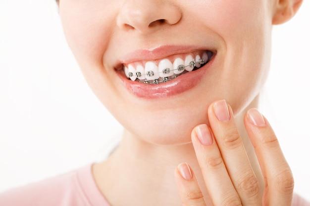  Can You Switch Metal To Ceramic Braces 