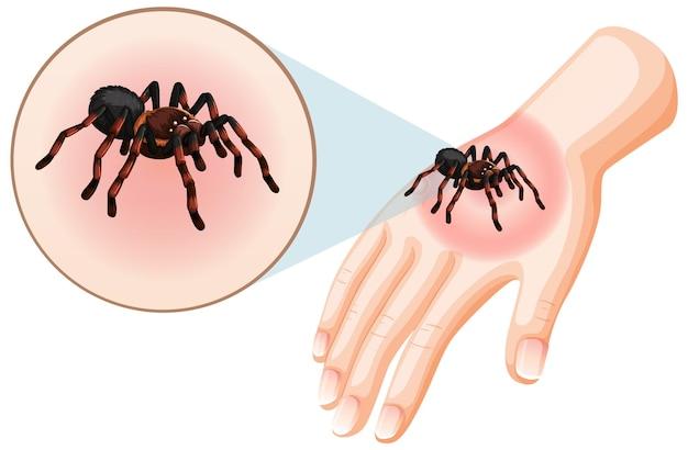 Can You Use Drawing Salve On Spider Bites 