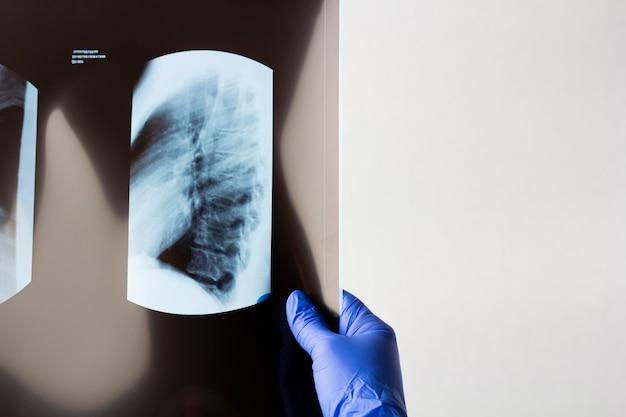  Does Carbon Paper Stop Xrays 