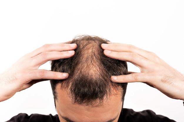  Does Soft Water Cause Hair Loss 
