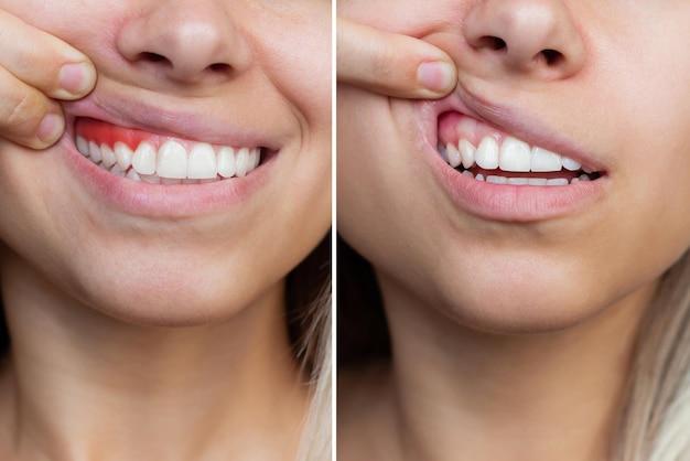  How Can Seniors Whiten Their Teeth 