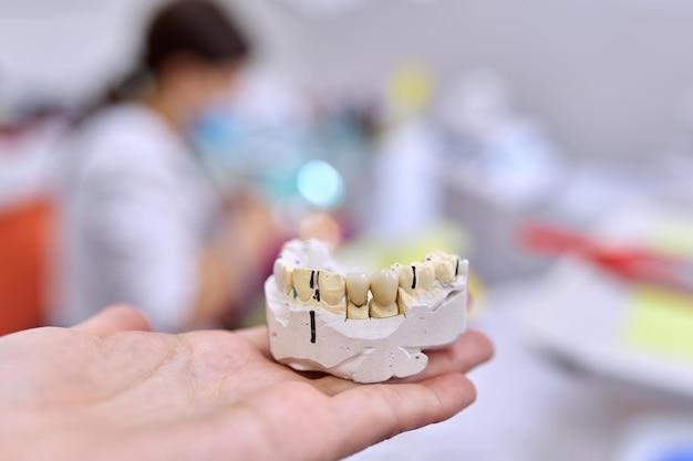  How To Etch Ceramic Crowns 