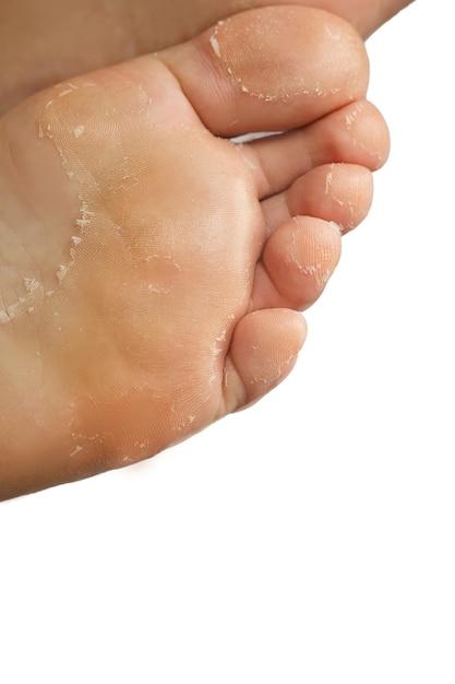 How To Get Rid Of Dead Skin On Feet With Baking Soda 
