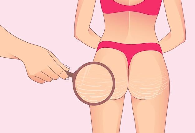 How To Get Rid Of Panty Lines On Skin 