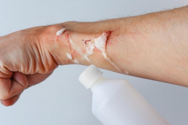How To Remove Dry Blood From Skin 