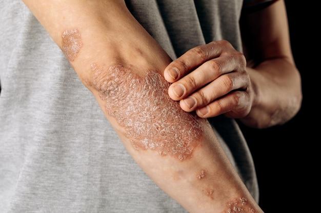 Is Nail Glue Dangerous On Skin 