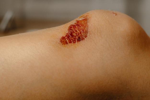 Does Soaking Wound In Salt Draw Out Infection 
